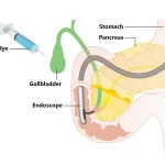 ERCP (Complex Post transplant)