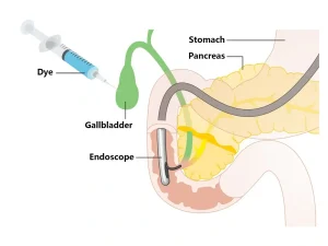 ERCP (Complex Post transplant)