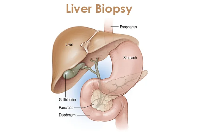 Liver Biopsy