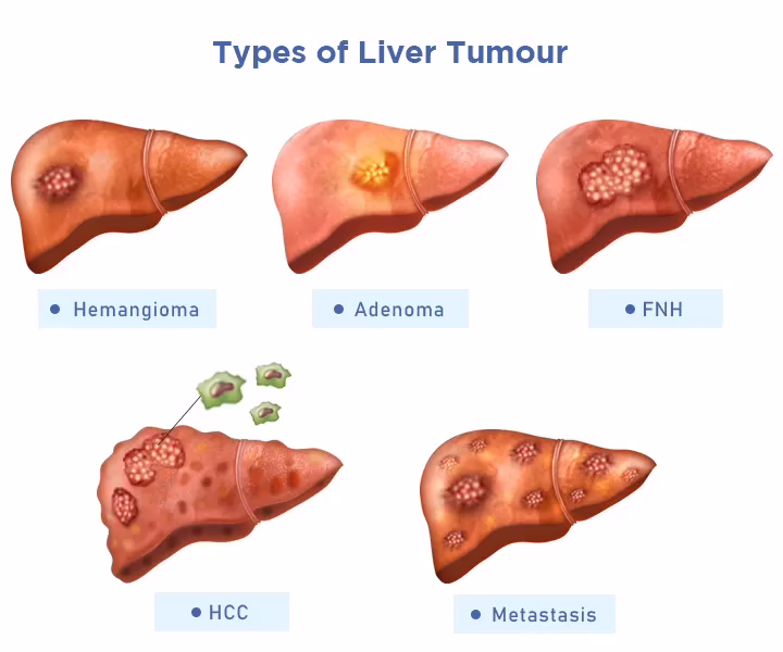 types of live cancer