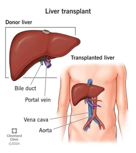 Liver Transplantation