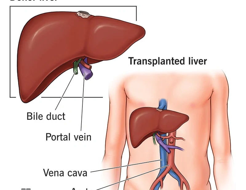 Liver Transplantation