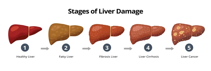 stages liver damange