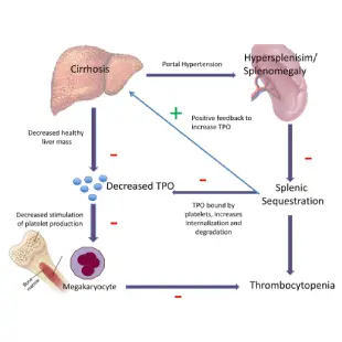Low platelets- earliest sign of portal hypertension and liver cirrhosis