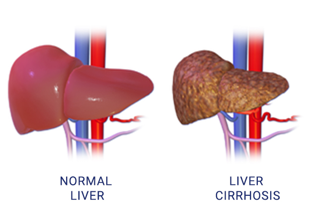 liver-cirrhosis